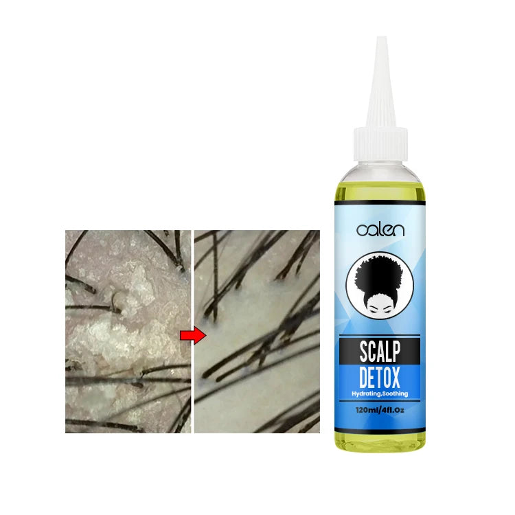 Oalen Custom Logo Pre-shampoo Scalp Oily Control SOOTHING SCALP RELIEF Scalp Detox