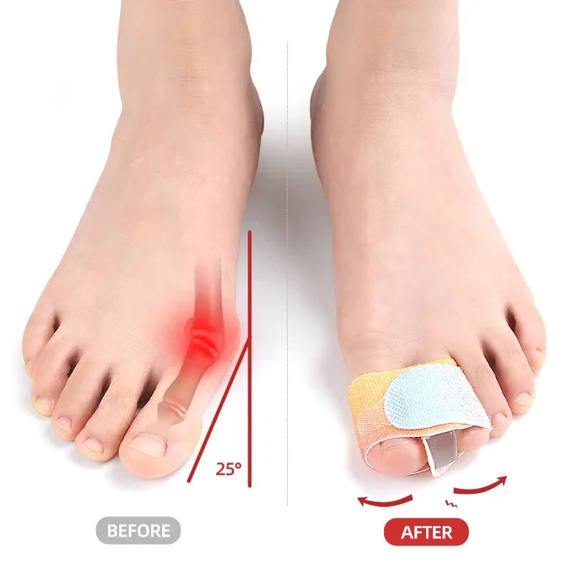 Hallux Valgus Toe Separator & Bunion Corrector - Big Toe Spacers for Pain Relief & Alignment