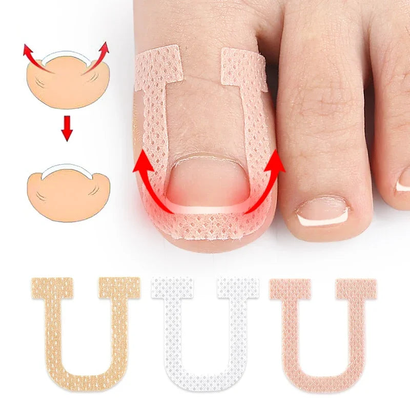 Melenlt U-Shape Toenail Correction Patch - Elastic Straightening Tool for Ingrown Nails and Nail Care