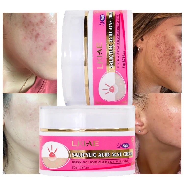 Anti Acne Facial Anti Button Cream Natural Anti Aging  Beauty Pimple Removing Skin  Lightening Face Cream
