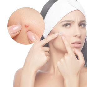 Customizable Private Label Hydrocolloid Pimple Patch Acne Skin Care Free Sample Main Collagen Organic Natural Herb Peptides