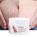 Strong Effective Acne Scar Removal Cream Pimples Stretch Marks Remove Face Gel Tummy Tuck Tightening Stretch Mark Removal Cream