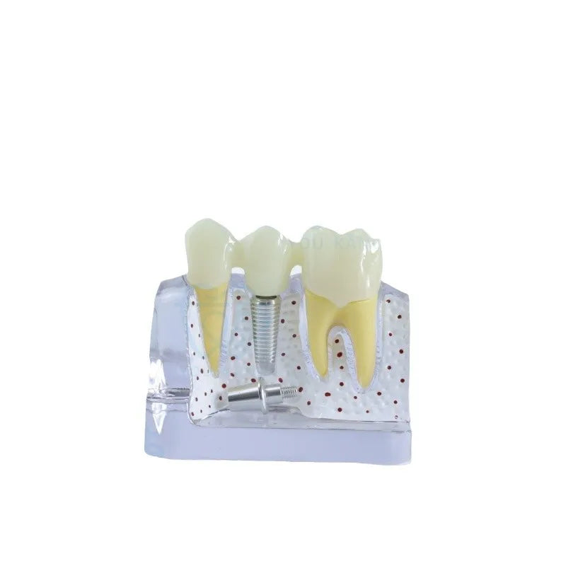 Oral Teaching Simulation Model Plastic Dental Implant with Removable Teeth Multi-Purpose Teeth Whitening Accessories