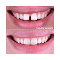 Top Fashion Teeth Whitening Strips Snap-On Porcelain Veneer Lab Resin Maker Kit Bonding Technology for Optimal Results