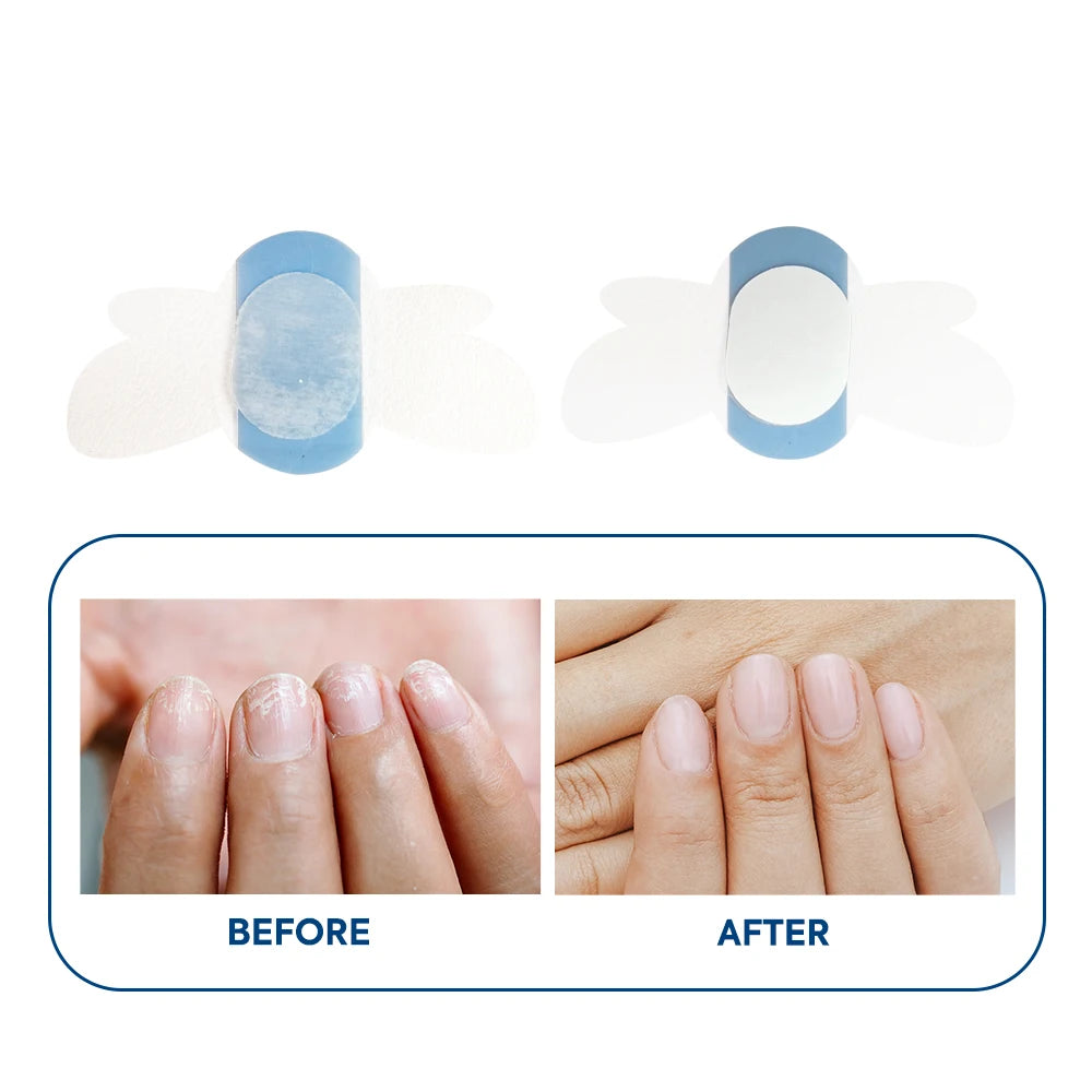 Beauty Hydrogel Patches for Broken Nails Keratin Gel Patch Waterproof Nail Sticker for Fungus