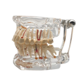 Clear Dental Implant Disease Teeth Model Dentist Transparent Standard Pathologic