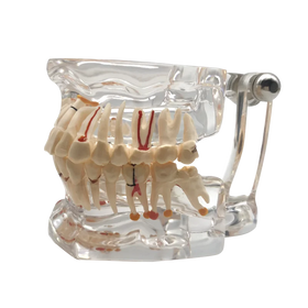 Clear Dental Implant Disease Teeth Model Dentist Transparent Standard Pathologic