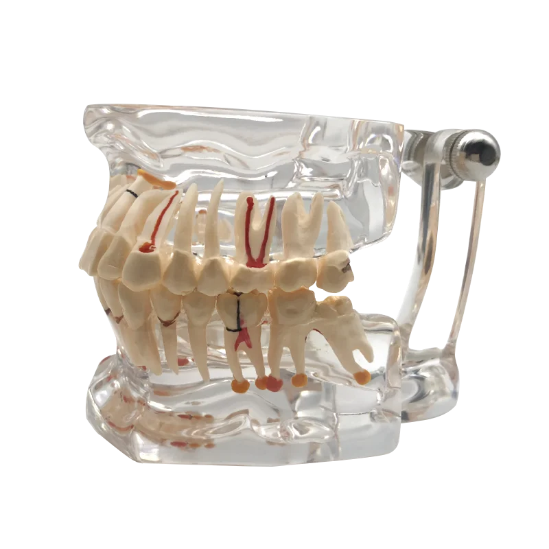Clear Dental Implant Disease Teeth Model Dentist Transparent Standard Pathologic