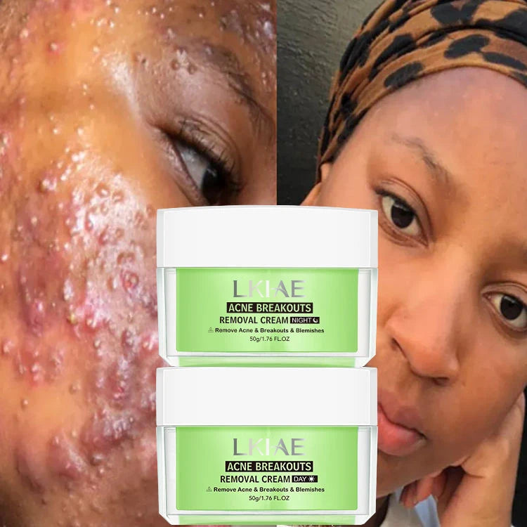 OEM&ODM Day Cream Acne & Dark Spot Removal Kit with Collagen & Glycerin for Sensitive Skin