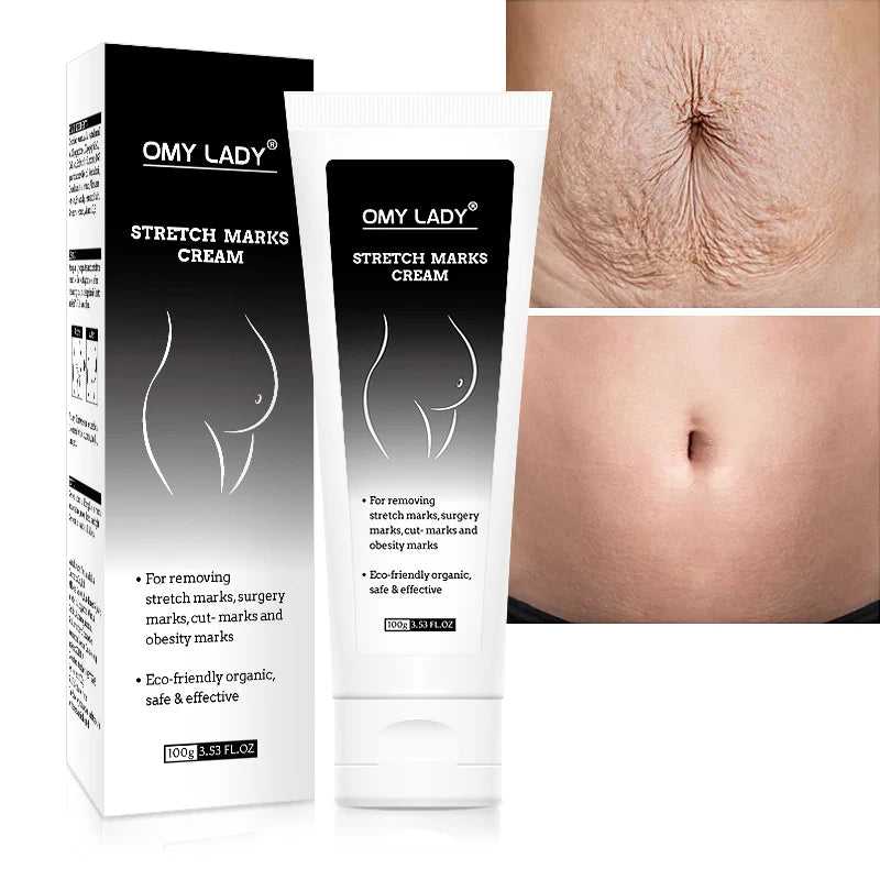Natural Herbal Formula Omy Lady Permanent Acne Scars Remover Anti Stretch Mark Cream Free Custom