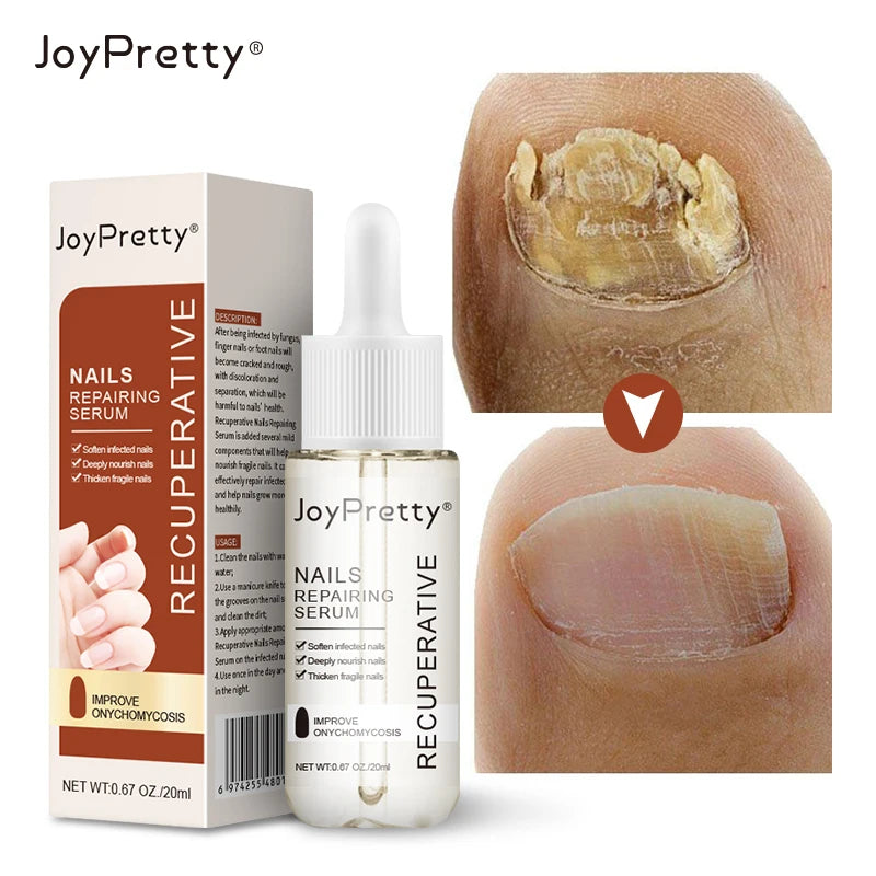 JoyPretty Fungal Nail Repair Serum Foot Repair Essence Care Whitening Toe Nail Fungus Removal Gel Anti Infection 20ml