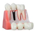 4 Times Medical Science Education Studying Dental Implant Model Removable Teeth Multi-Purpose Teeth Whitening Accessories