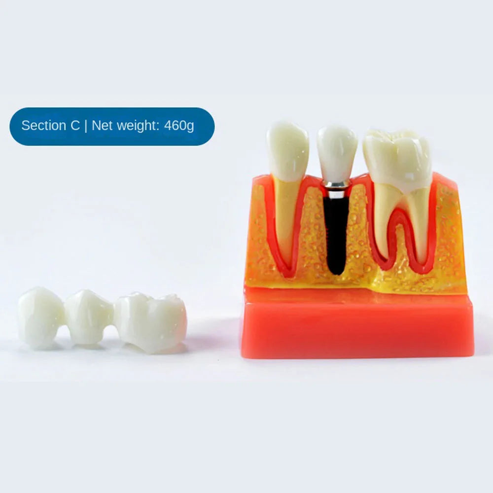 Durable Plastic Dental Teeth Model 4 Times Teaching Model for Doctor-Patient Multi-Purpose Teeth Whitening Accessories
