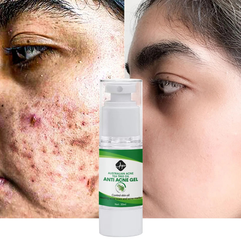 OEM/ODM Private Label Tea Tree Pimples Dark Spot Remover Scar Deep Cleaning Face Skin Care Repair Acne Gel Cream