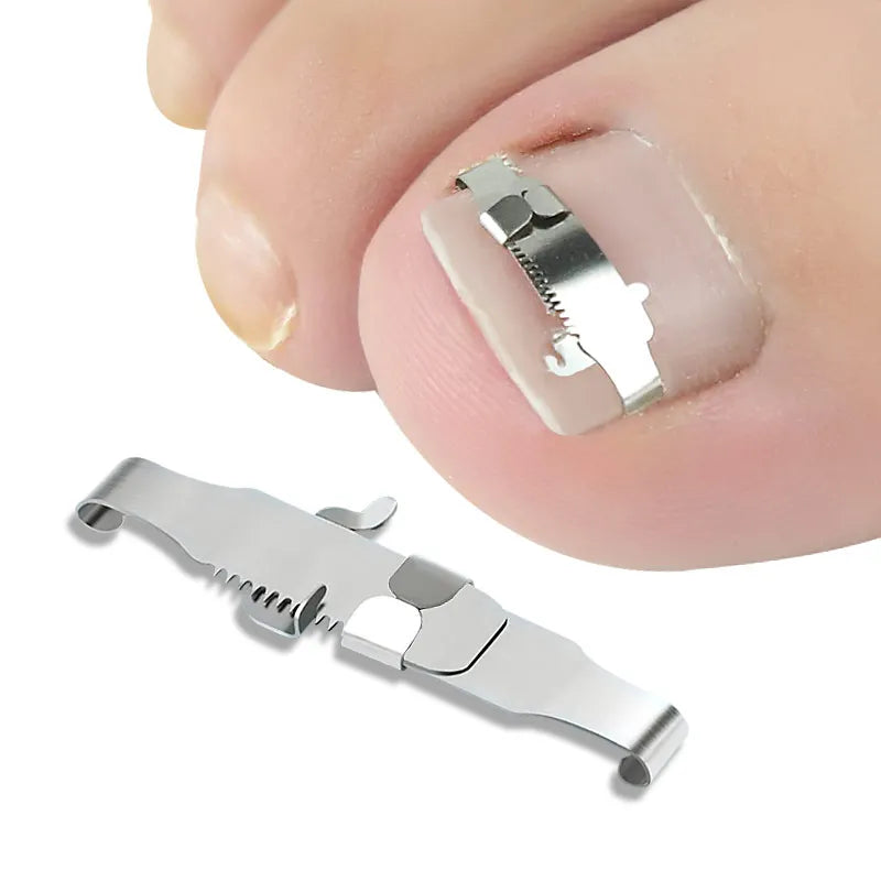 Ingrown Toenail Corrector  Nail Care Tool with Straightening Clip and Curved Brace for Paronychia and Thick Toenail Correction