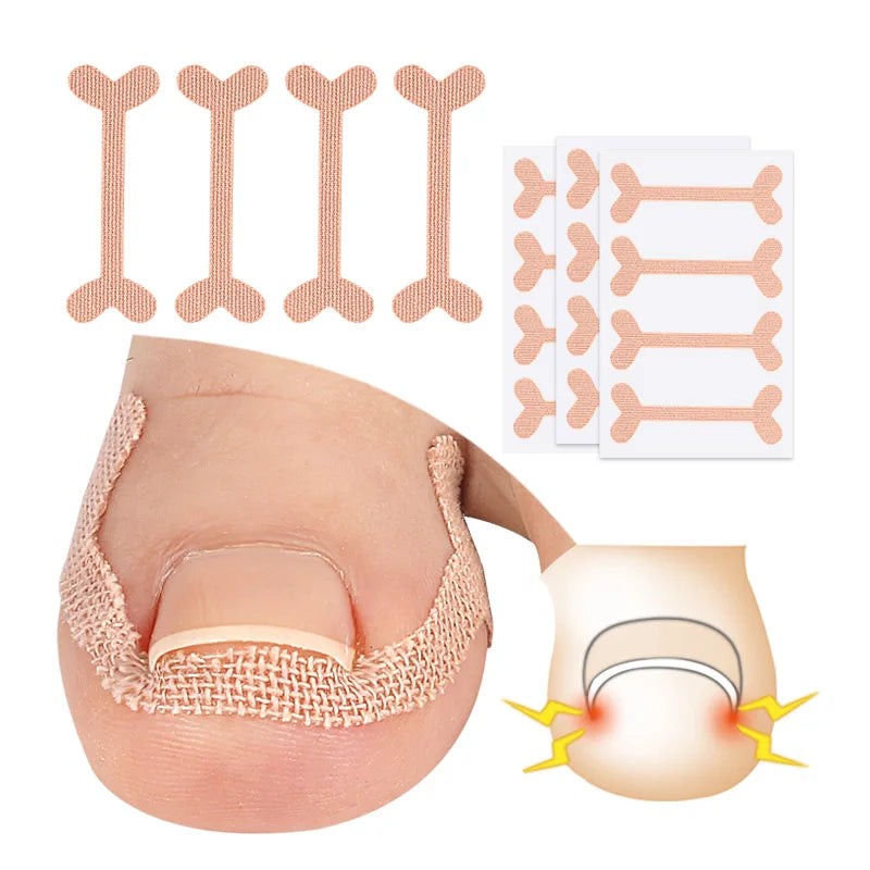 Pedicure Ingrown Toenails Correct Patch Manicure & Pedicure Set with Straightening Sticker Brace Model 33080032