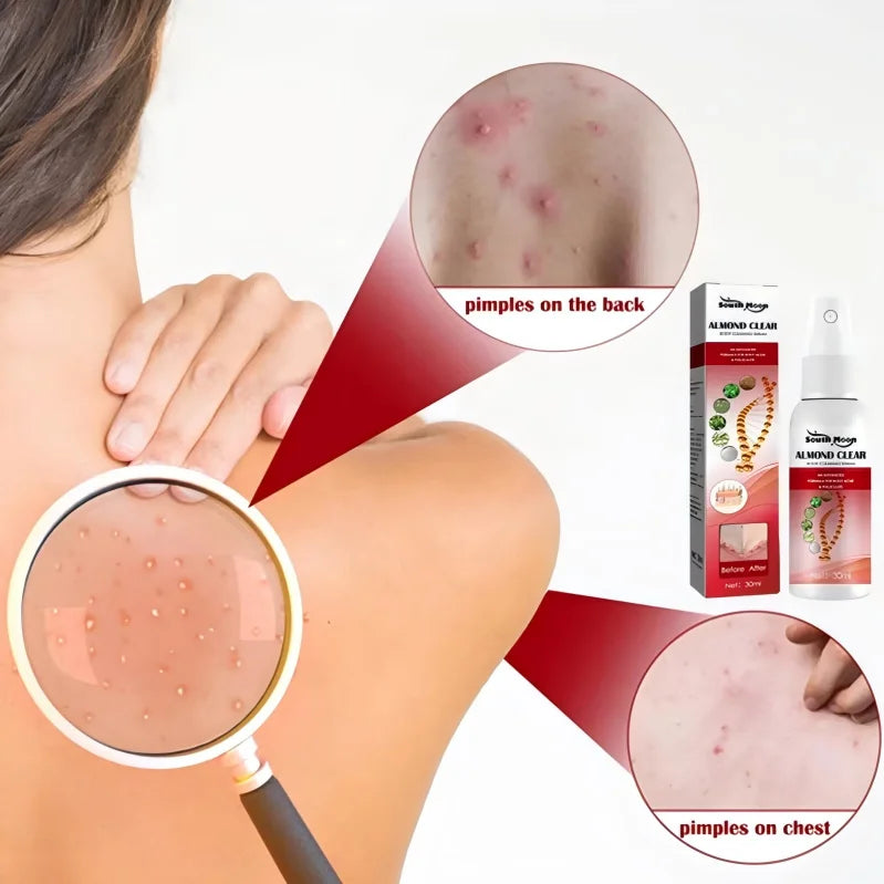 Private Label Oem South Moon 30ml Abscess Nuchal Induration Folliculiti Treatment Almond Clear Body Clearing Serum
