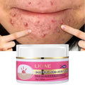 Wholesale OEM/ODM Vegan Facial Care Anti-Acne Cream Salicylic Acid Vitamin C for Acne Scar Removal Whitening Moisturizing