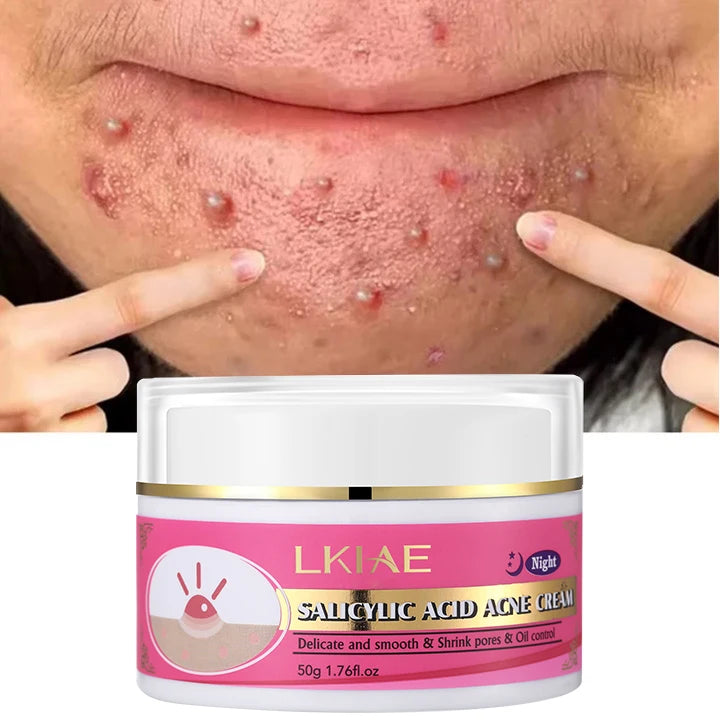 Wholesale OEM/ODM Vegan Facial Care Anti-Acne Cream Salicylic Acid Vitamin C for Acne Scar Removal Whitening Moisturizing