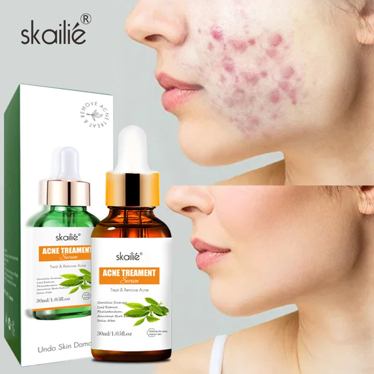 Private Label Skin Care Brightening Hydrating Repair Facial Tea Tree Acne Care Serum