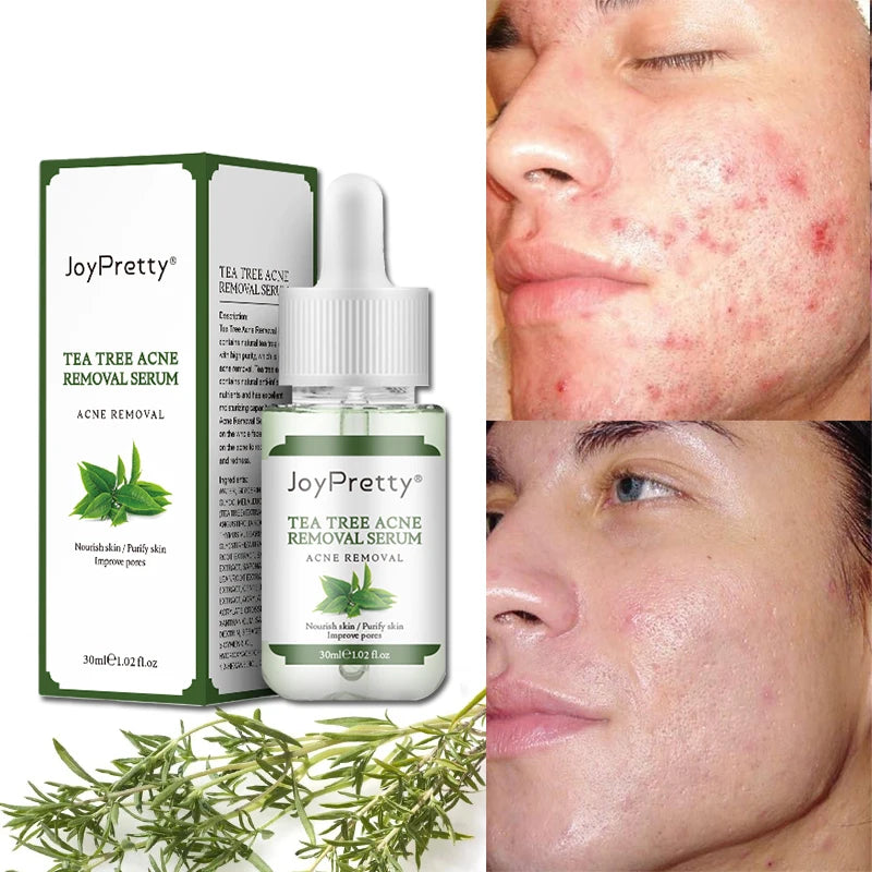 Anti Acne Facial Skin Care Serum Lightening Acne Scar Remove Pimples Blacked Oil Control Deep Moisturizing Tea Tree Serum