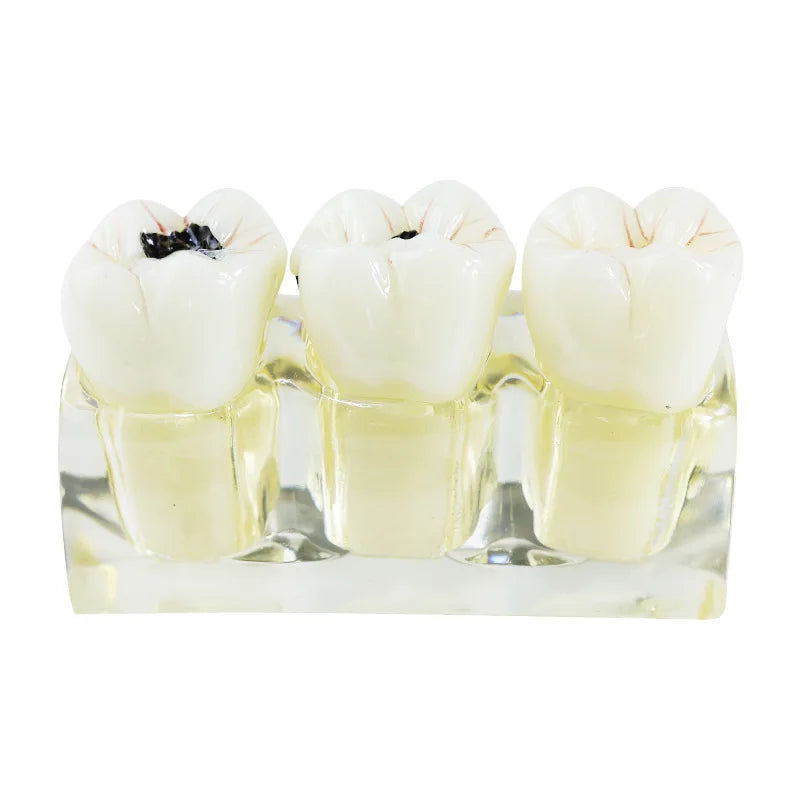 4 Times Removable Pathological Dental Model Caries Tooth Anatomy Education Teeth Model Decomposition Multi-Purpose Oral Hygiene