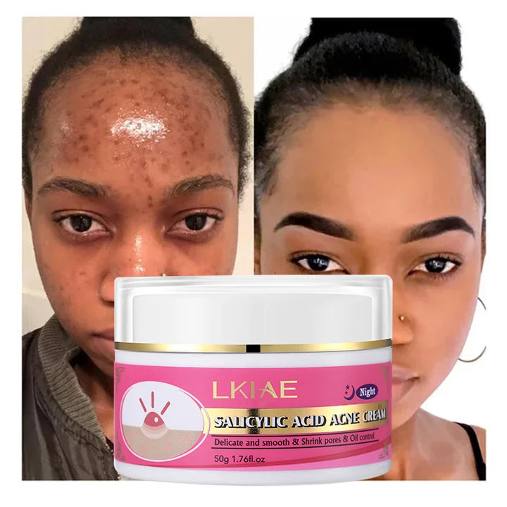 Private Label Organic Natural Collagen Skin Brightening Acne Salicylic Acid Pimple Removal Facial Skincare Treatment Cream