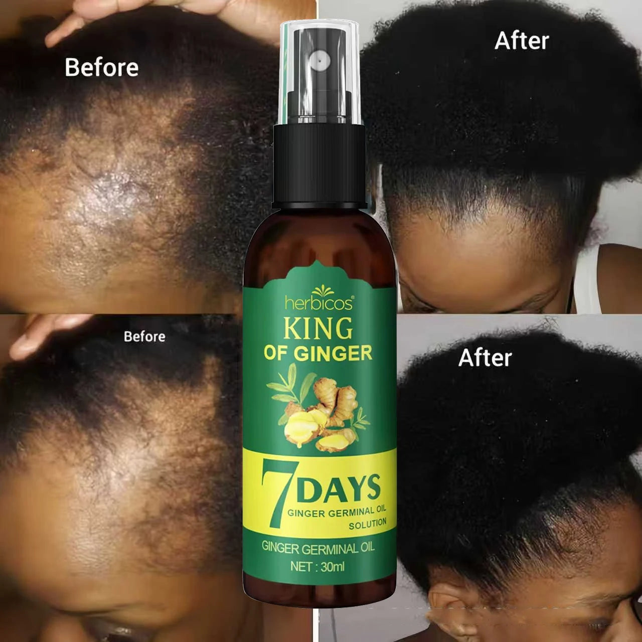 Herbicos 30ML Hair Loss Treatment Serum Germinal Essential Oil Ginger Hair Growth Oil