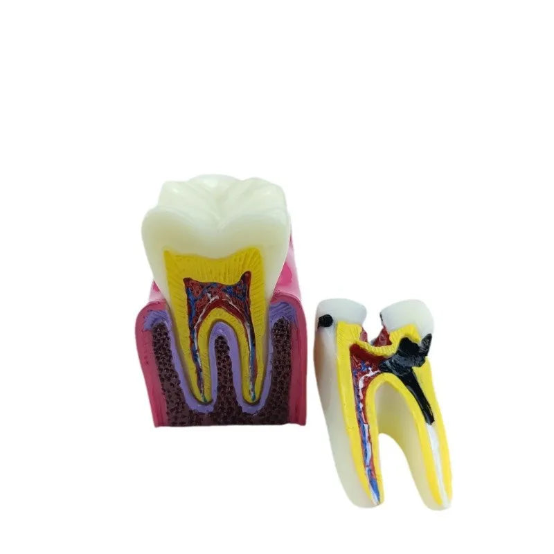 Manual Dental Teaching Equipment for Caries Detection Oral Therapy Accessories 6 Times Contrast Model for Teaching Oral Tooth