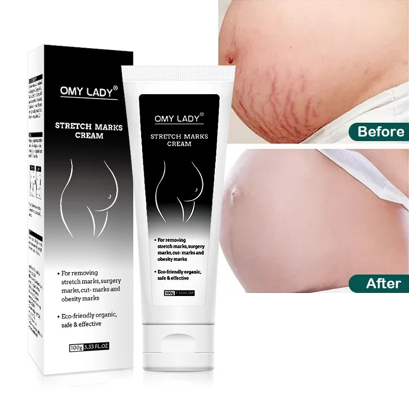 Wholesale OMY LADY Mango Pregnancy Stretch Marks Repair Scar Slack Line Abdomen Stretch Mark Cream