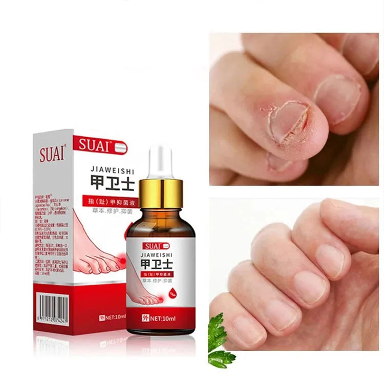 Anti Fungal Treatment Nail Onychomycosis Paronychia Infection Toe Finger Repair Nails