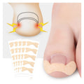 Ingrown Toenails Corrector Nail Care Tool Straightening Clip Curved Brace Toenails Thick Paronychia Correction Foot Care