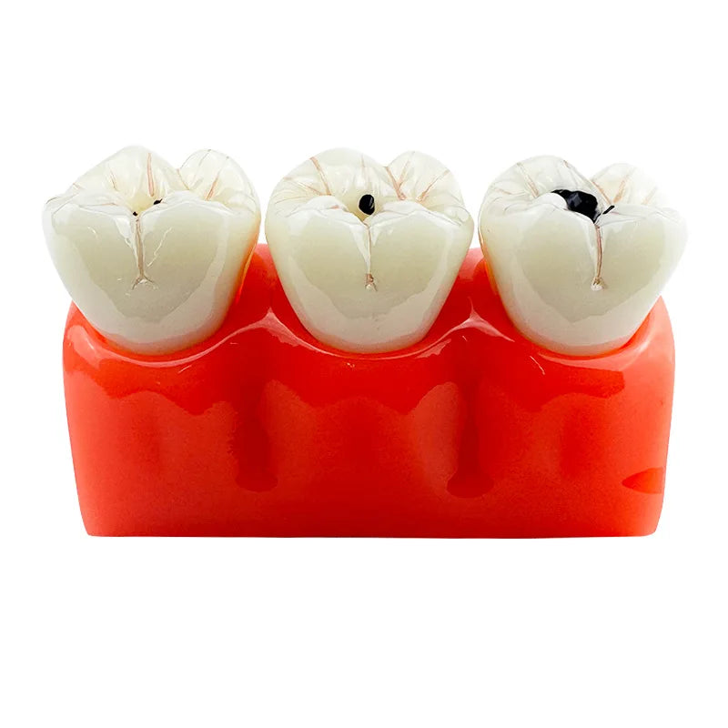 FUREIN SMILE 4-Times Removable Pathological Dental Model Caries Tooth Anatomy Education Teeth Multi-Purpose Oral Hygiene PVC