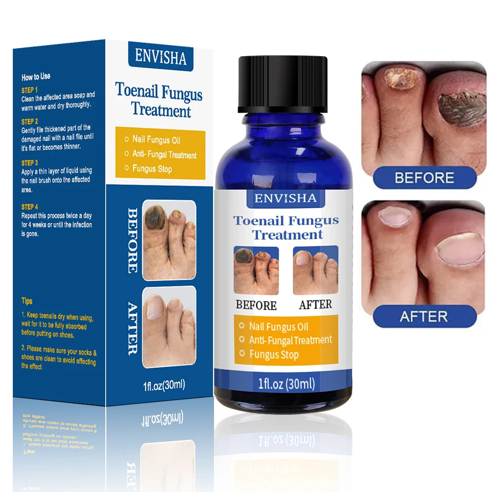 Fungal Nail Treatment Feet Care Nail Foot Whitening Toe Nail Fungus Removal Gel Anti Infection Paronychia Onychomycosis