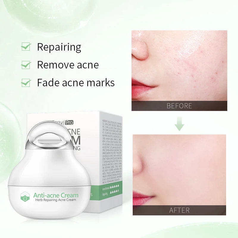 Fenyi Pro Herb Exfoliating Oil Controlling Acne Removing Pores Shrinking Skin Moisturizing Smoothing Repairing Face Cream