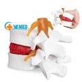 Human Lumbar Disc Herniation Spine Model 1.5X Intervertebral Disc Model Anatomical Vertebrae Disc Model for School Teaching