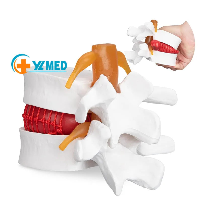 Human Lumbar Disc Herniation Spine Model 1.5X Intervertebral Disc Model Anatomical Vertebrae Disc Model for School Teaching