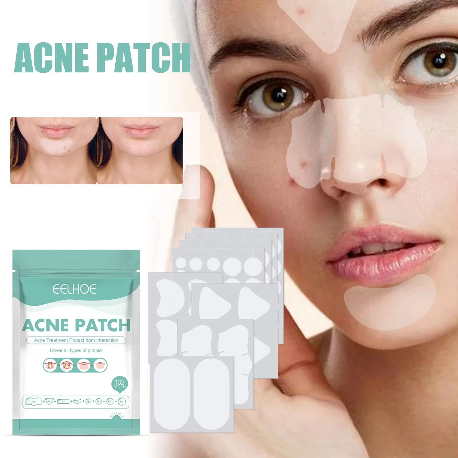 EELHOE 100% Pure Natural Herbal Ingredients Mild Non-irritating Lighten Acne Marks Repairing Hydrocolloid Pimple Acne Patch Body
