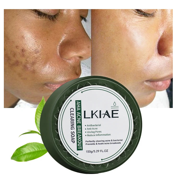OEM ODM Beauty Natural Glycerine AHA Soothe Skin Reduce Inflammation Acne Breakout Clearing Foam Hotel Soaps for Face Acne