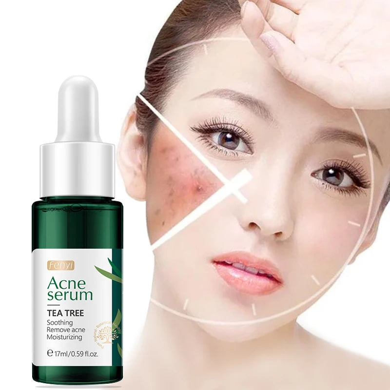 Fenyi 17ml Skin Hydrating Moisturizing Nourishing Soothing Essence Pimple Mark Removing Tea Tree Acne Serum for Face