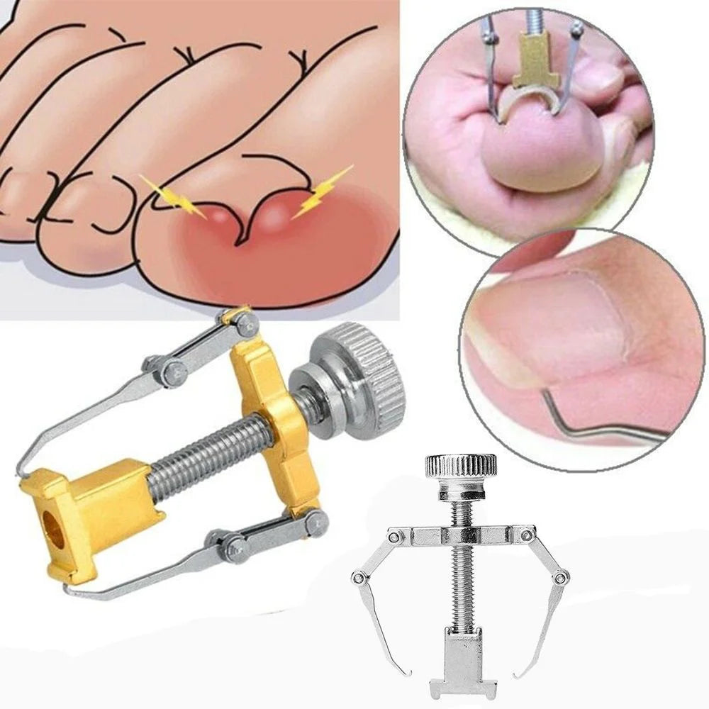 Epsilon Ingrown Toenails Correction Nail Fixer Care Tools File Elastic Patch Straightening Clip Brace Corrector Wire Fixer Set
