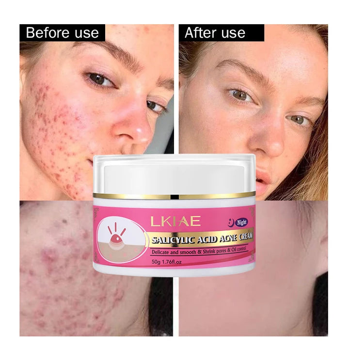 50ml Vegan Skin Care Niacinamide Collagen Moisturizing Skin Oil Control Acne Pimple Mark Removal Lightening Acne Face Cream