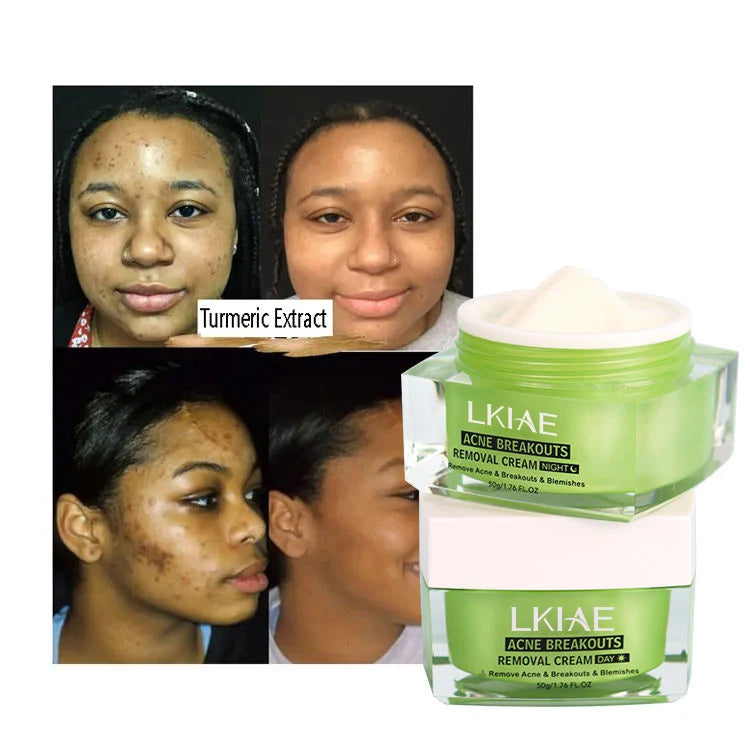 OEM ODM Acne Cream with Kojic Acid Niacinamide & Collagen for Brightening Pimple Removal and Balanced Skin Care 50g