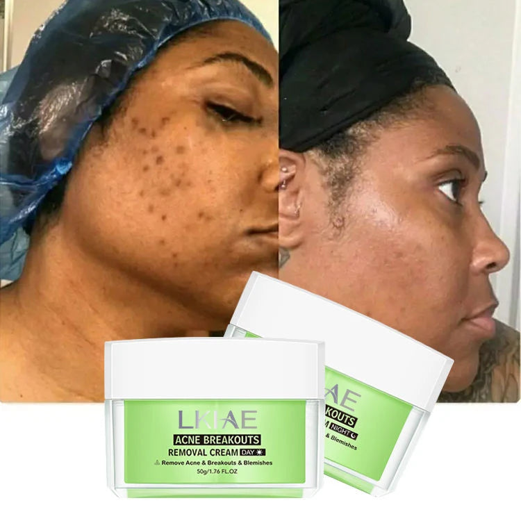 Organic Facial Skin Care Anti-Acne Dark Spot Blackhead Remover Acne Kit with Niacinamide & Collagen for Firming & Moisturizing