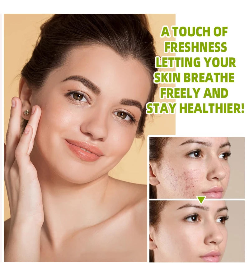 Wholesale Organic  Herbal Fomula Removal Cream Shrink Pores Vegan Herbal Extract Acne Cream Pores Treatment Cream