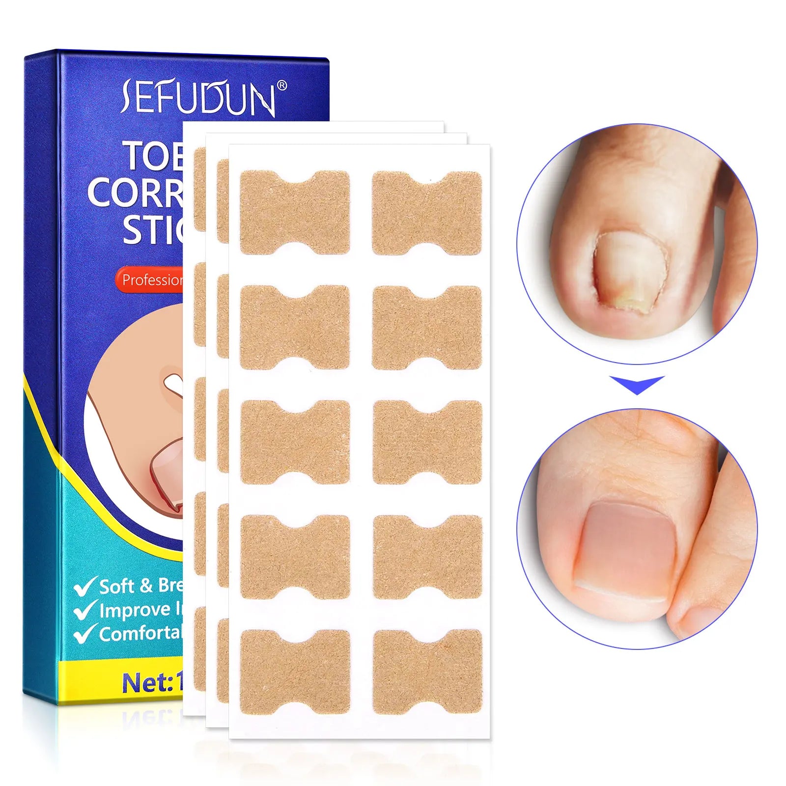 SEFUDUN Wholesale Ingrown Toenail Correction Stickers Toe Nail Treatment Breathable Ingrown Toenail Corrector Patches