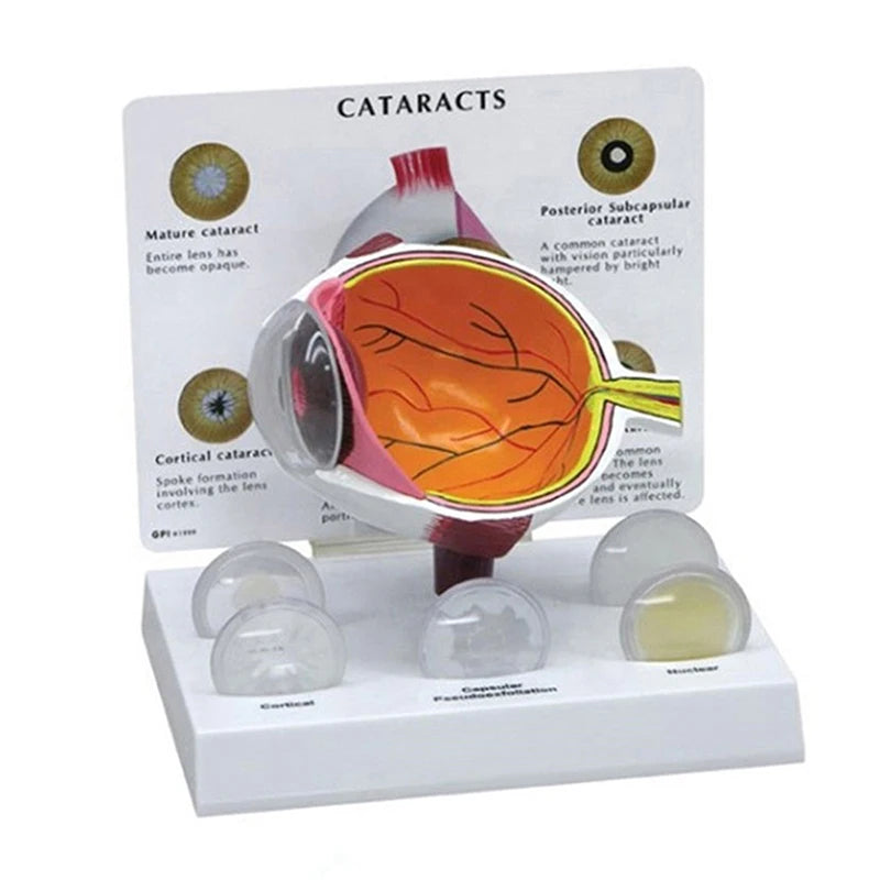 Educational Advance Eye Enlargement Anatomical 3 Parts 3D Plastic Cataracts Medical Science Human Eye Model for Teaching MegaBDM