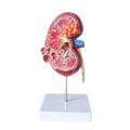 Diseased Lesion Kidney Anatomical Model Normal Kidney Model
