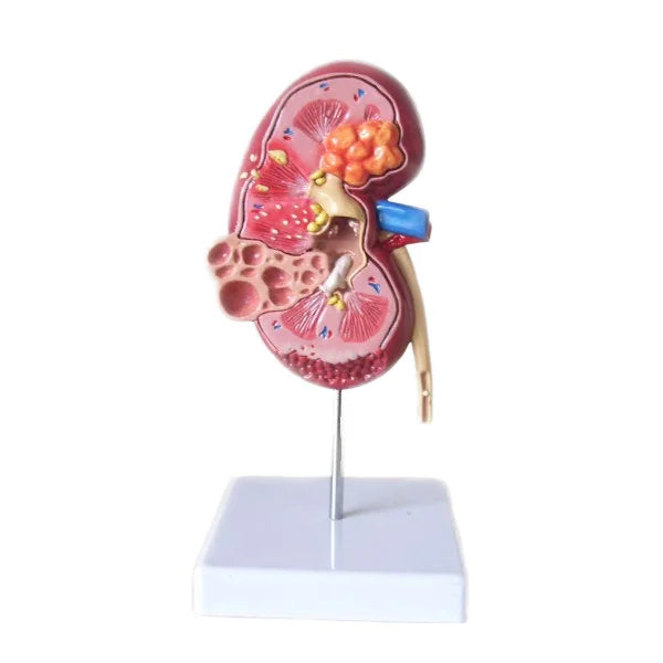 Diseased Lesion Kidney Anatomical Model Normal Kidney Model