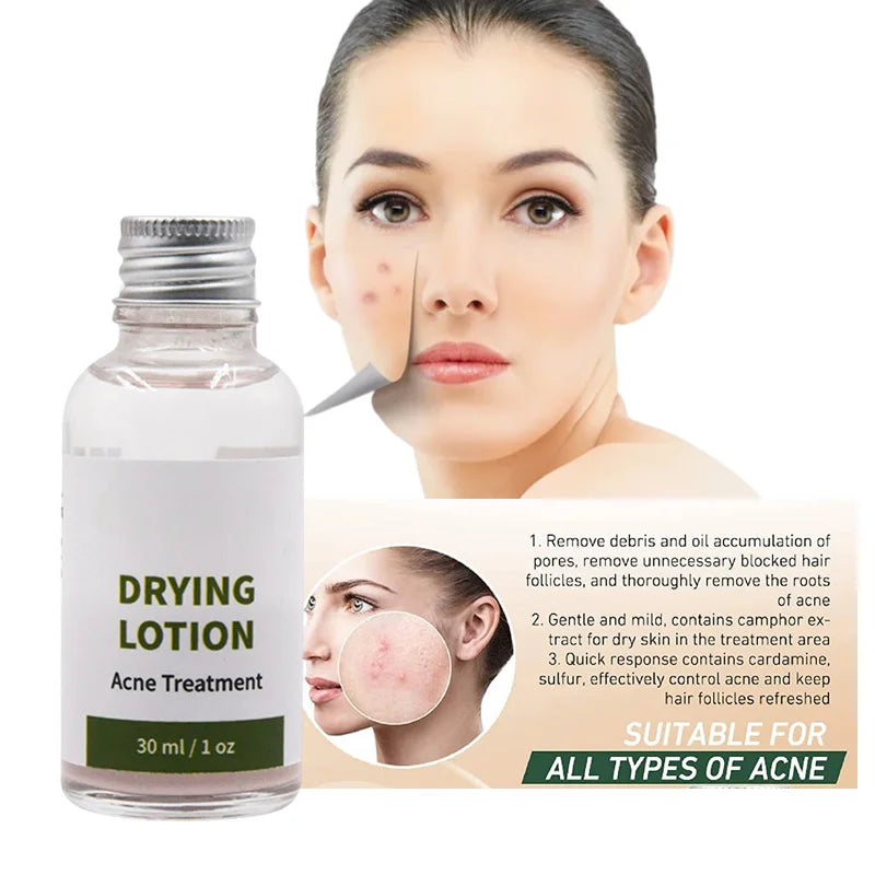 Manufacturer OEM ODM Green Tea Aloe Vera Anti-Acne Pimple Removing Serum Liquid 30ml Drying Lotion for Face Anti-Aging
